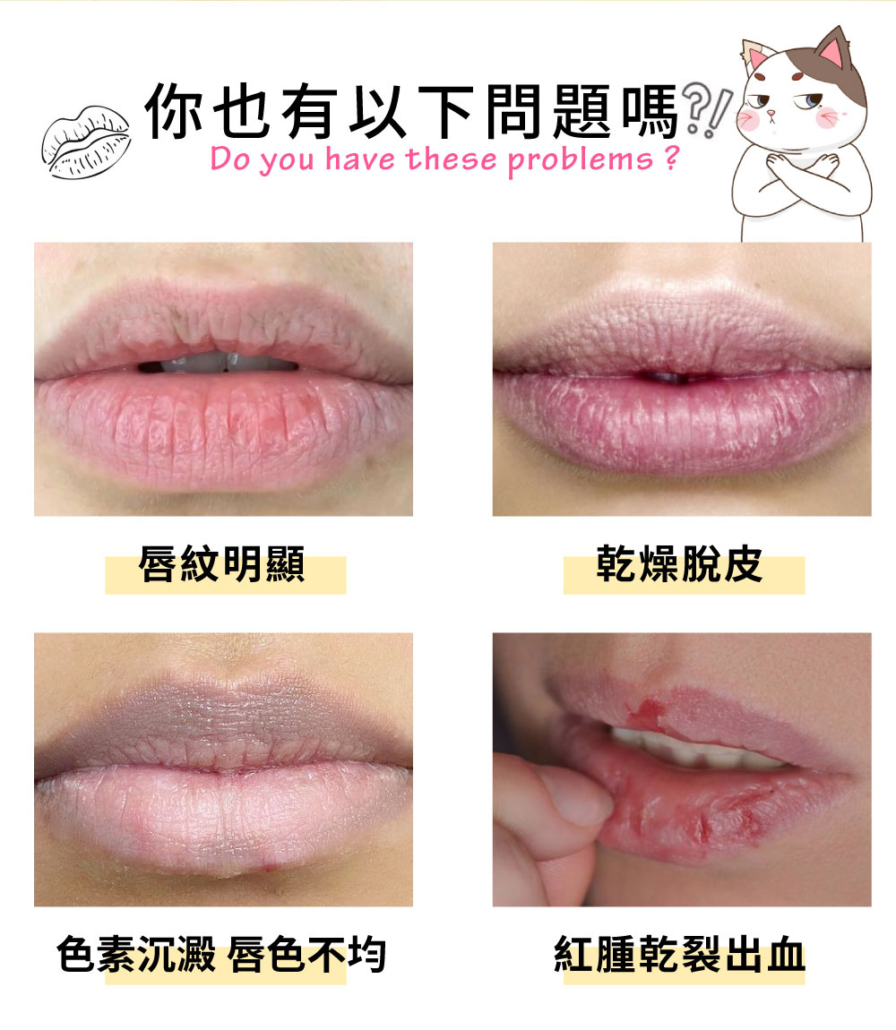 你也有以下問題嗎 唇紋明顯 乾燥脫皮 色素沉澱 唇色不均 紅腫乾裂出血